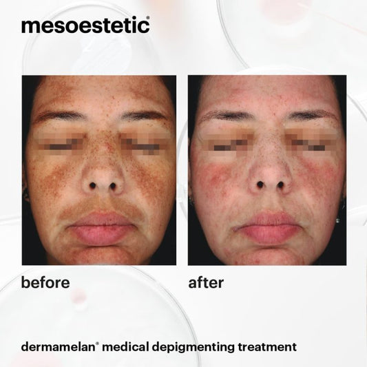 Cosmelan vs Dermamelan: Which One Is Better for Stubborn Dark Spots?