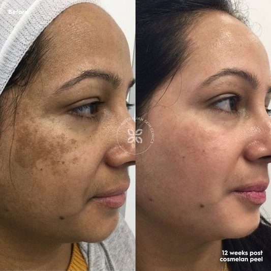Cosmelan Aftercare: What No One Tells You