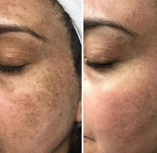Why the Cosmelan Pack No Longer Peels the Skin Like Before?