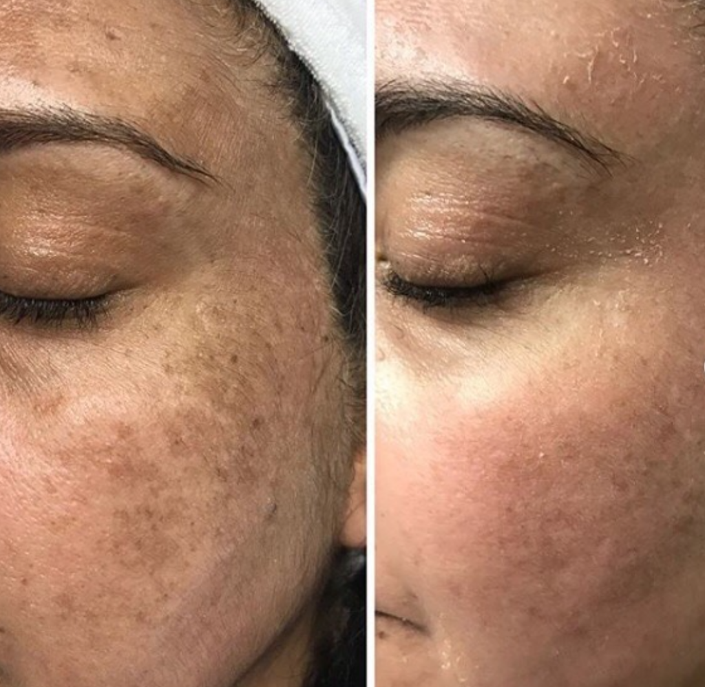 Why the Cosmelan Pack No Longer Peels the Skin Like Before?